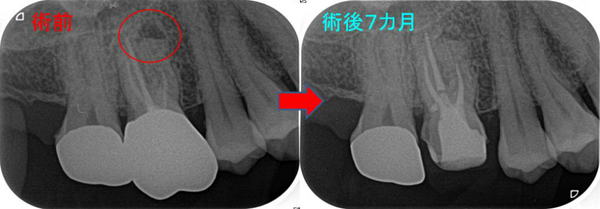 治癒の歯内療法 CI4-12.jpg?fit=1939,1503&ssl=1